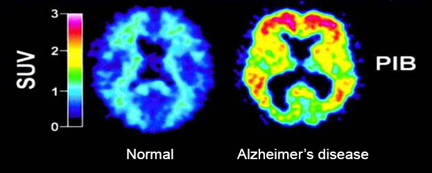 Amyloid PET in the Older Australian Twins Study - PET Brain Scan